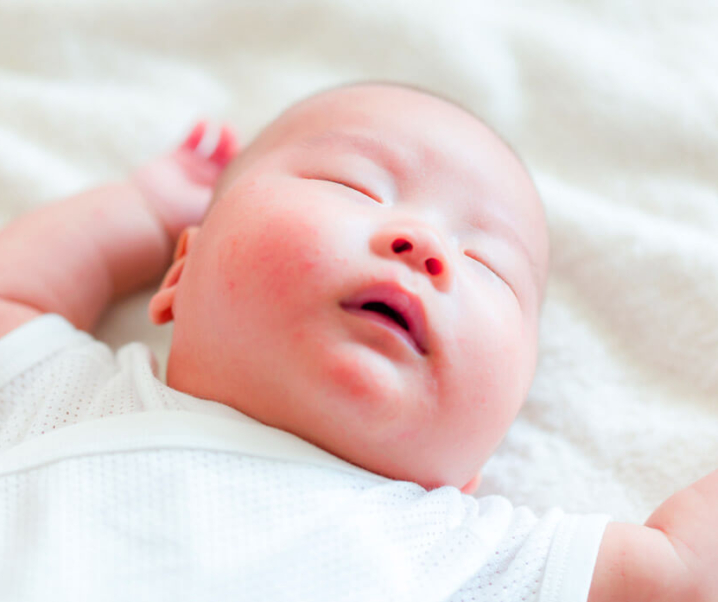 Granitos cara bebé: causas, síntomas y soluciones